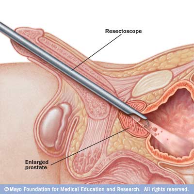 Video of transurethral resection of the prostate anesthesia